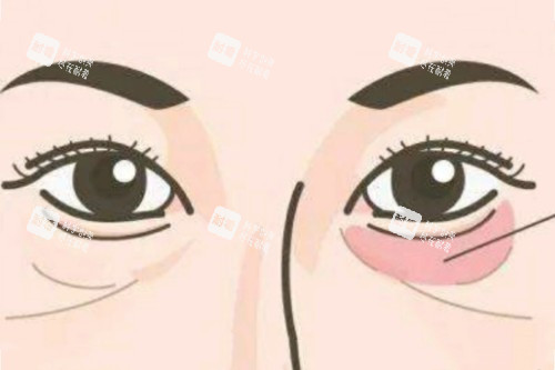 眼袋卡通图.jpg 眼袋卡通图.jpg