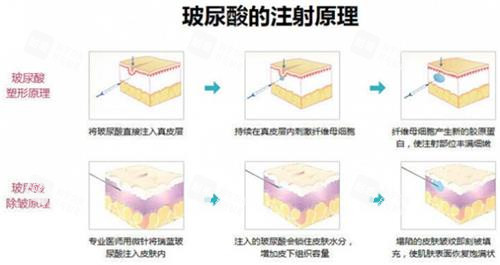 玻尿酸注射原理.jpg 玻尿酸注射原理.jpg