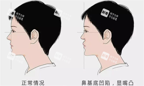 鼻基底凹陷填充.jpg 鼻基底凹陷填充.jpg