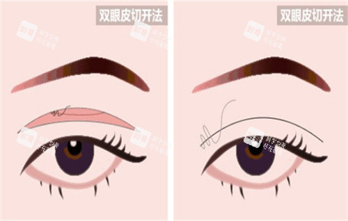 全切双眼皮手术的切口部位.jpg 全切双眼皮手术的切口部位.jpg