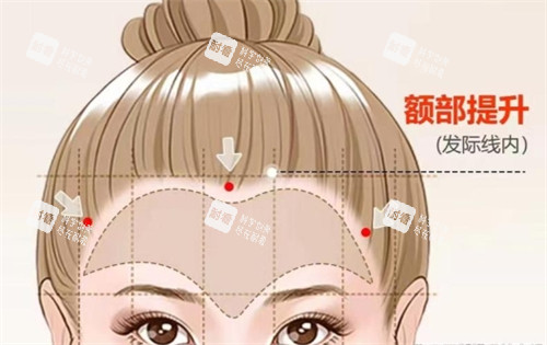 额部提升所定位切口的位置.jpg 额部提升所定位切口的位置.jpg