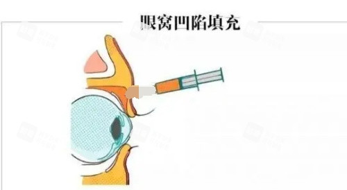 眼窝凹陷填充.jpg 眼窝凹陷填充.jpg