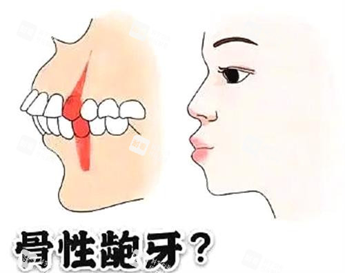 骨性龅牙和齿性龅牙 骨性龅牙和齿性龅牙