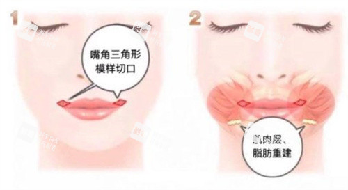 微笑唇手术.jpg