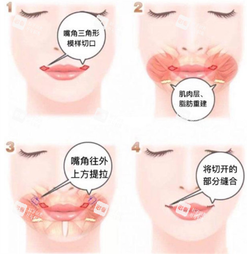 微笑唇手术步骤图解.jpg