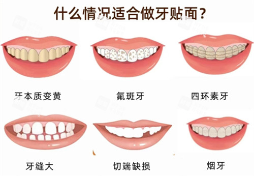 适合做牙贴面的情况.jpg 适合做牙贴面的情况.jpg
