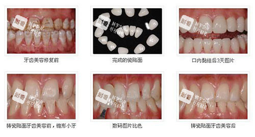不同方式牙齿美白示意图.jpg 不同方式牙齿美白示意图.jpg