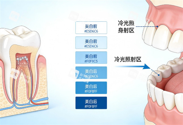 牙齿冷光美白治疗示意图.jpg 牙齿冷光美白治疗示意图.jpg