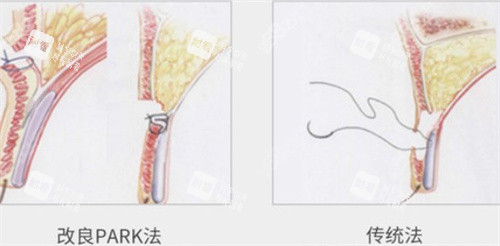 park双眼皮和传统对比.jpg park双眼皮和传统对比.jpg