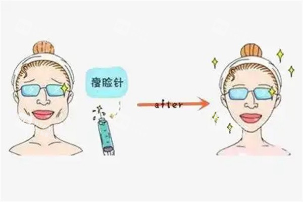 咬肌缩小.jpg 咬肌缩小.jpg