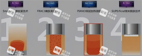 fotona4d欧洲之星四种模式.jpg