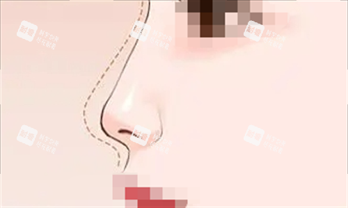 隆鼻预期弧度动画呈现图.png 隆鼻预期弧度动画呈现图.png