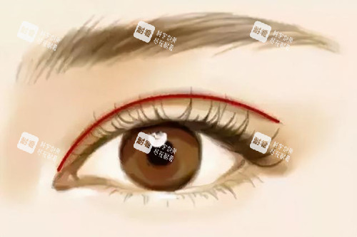 开扇形双眼皮.jpg 开扇形双眼皮.jpg
