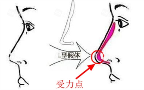 L形隆鼻假体对比.jpg L形隆鼻假体对比.jpg