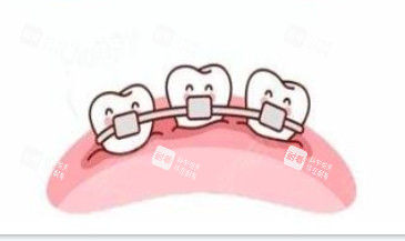 隐形牙齿和传统牙齿矫正器展示图.png