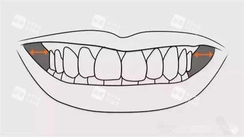牙齿矫正扩牙弓颊廊.jpg