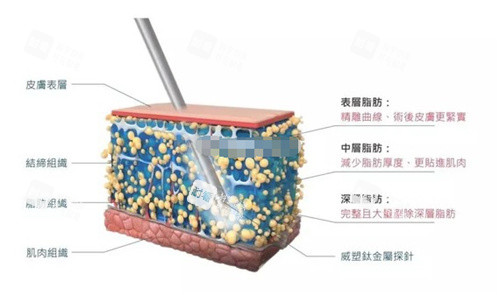 玲珑体雕吸脂.jpg 玲珑体雕吸脂.jpg