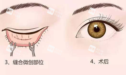 内切祛眼袋展示图.jpg