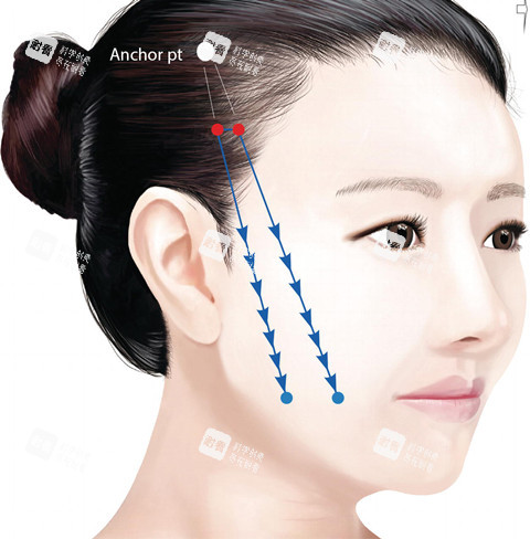 面部线提升卡通图.jpg