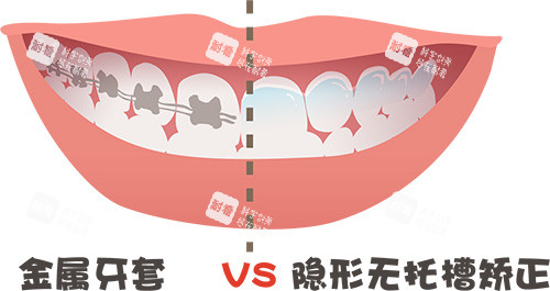 牙齿矫正牙套金属对比隐形牙套.jpg 牙齿矫正牙套金属对比隐形牙套.jpg