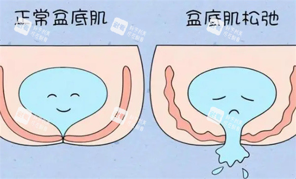 盆底肌修复图片.jpg