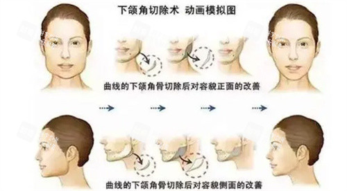 下颌角整形对比.jpg 下颌角整形对比.jpg