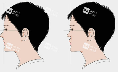 鼻基底填充前后对比卡通示意图.jpg