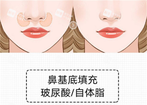 鼻基底填充前后对比图.jpg