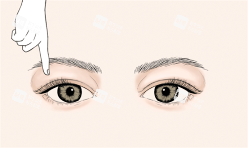 双眼皮手术设计.png 双眼皮手术设计.png