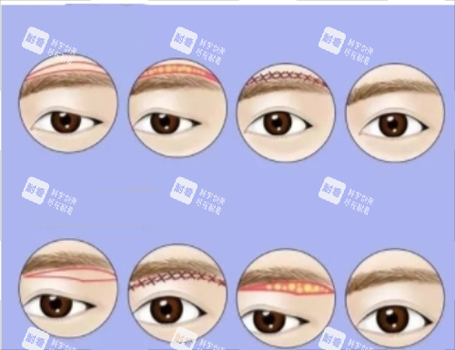 提眉手术完整流程图.png 提眉手术完整流程图.png