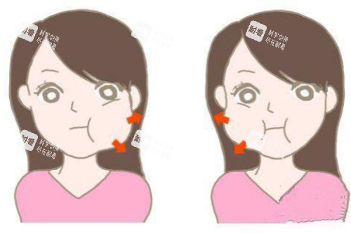 咬肌肥大卡通图.jpg 咬肌肥大卡通图.jpg