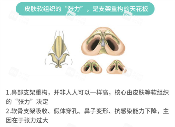 隆鼻方案怎么选.jpg 隆鼻方案怎么选.jpg