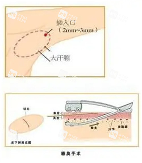 腋臭手术过程图解.jpg 腋臭手术过程图解.jpg