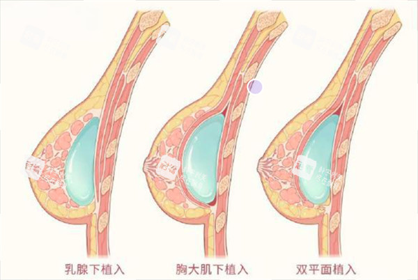 隆胸假体植入层次.png