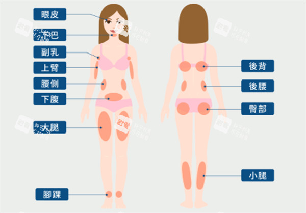 常见吸脂部位.jpg
