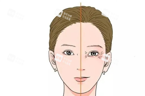 眼部皱纹.webp.jpg 眼部皱纹.webp.jpg