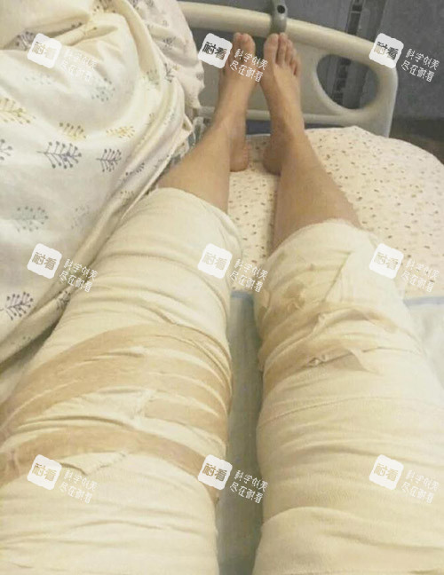 大腿吸脂照片.jpg 大腿吸脂照片.jpg