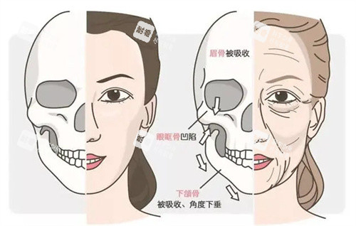 年轻和老化的面部骨骼.jpg 年轻和老化的面部骨骼.jpg