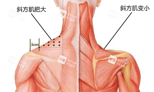斜方肌注射前后展示图.jpg 斜方肌注射前后展示图.jpg