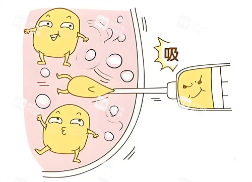 吸脂.jpg 吸脂.jpg