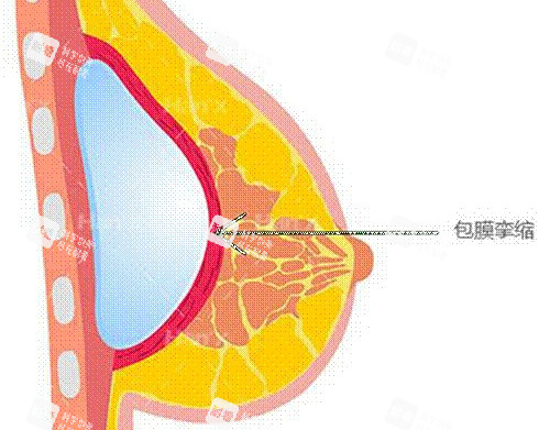 假体丰胸薄膜挛缩示意图.jpg 假体丰胸薄膜挛缩示意图.jpg
