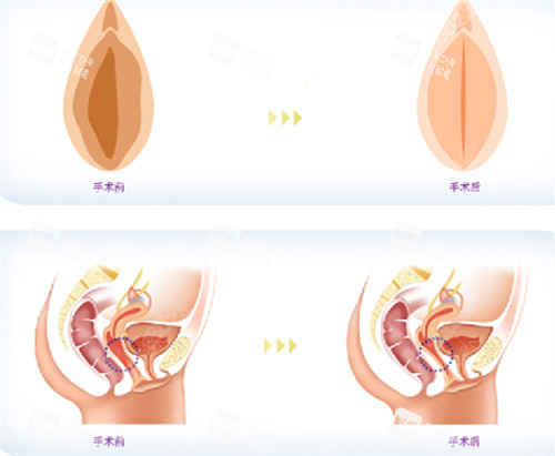 私密整形前后对比图.jpg