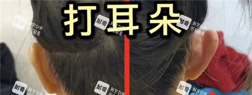 精灵耳注射图.jpg