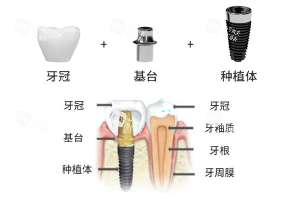 威高种植牙手术过程示意图.jpg 威高种植牙手术过程示意图.jpg