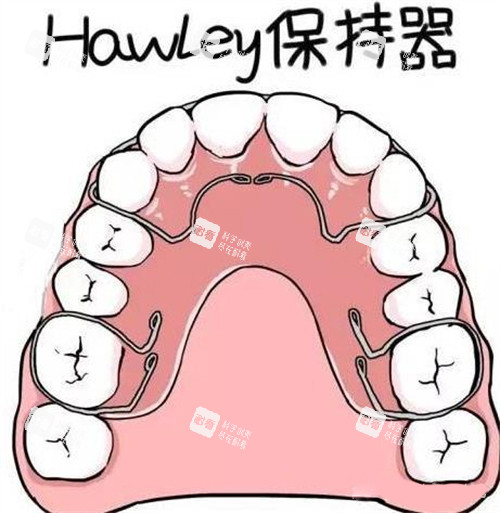 牙齿矫正Hawley哈雷保持器.jpg 牙齿矫正Hawley哈雷保持器.jpg