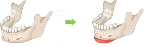 下巴截骨.jpg 下巴截骨.jpg