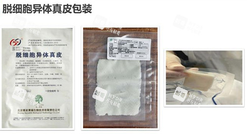 3d生物束带紧缩术材料包装示意图.jpg 3d生物束带紧缩术材料包装示意图.jpg
