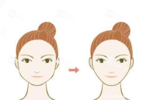 下颌角整形卡通前后对比图.jpg 下颌角整形卡通前后对比图.jpg