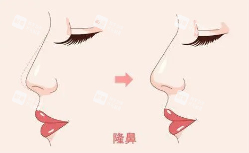 隆鼻对比图.JPG 隆鼻对比图.JPG
