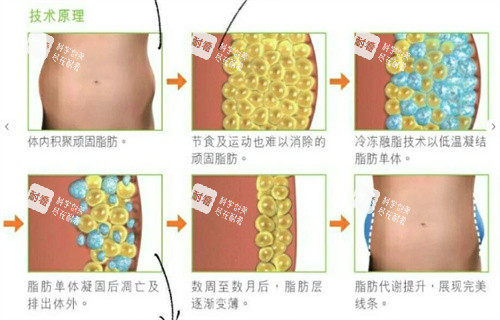 酷塑冷冻溶脂.jpg